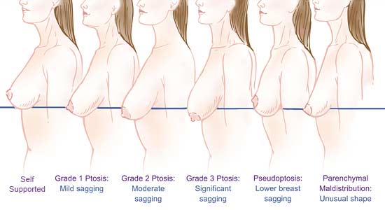 pendulous breast diagram